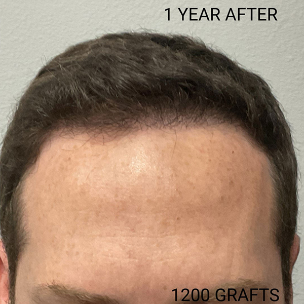 Hair Transplant