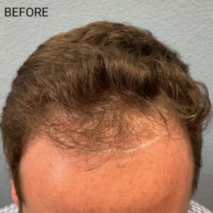 Hair Transplant